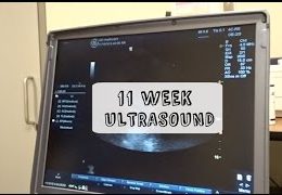 First Ultrasound 11 Weeks